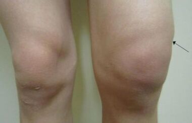 Manifestations cliniques de l'arthrose de l'articulation du genou