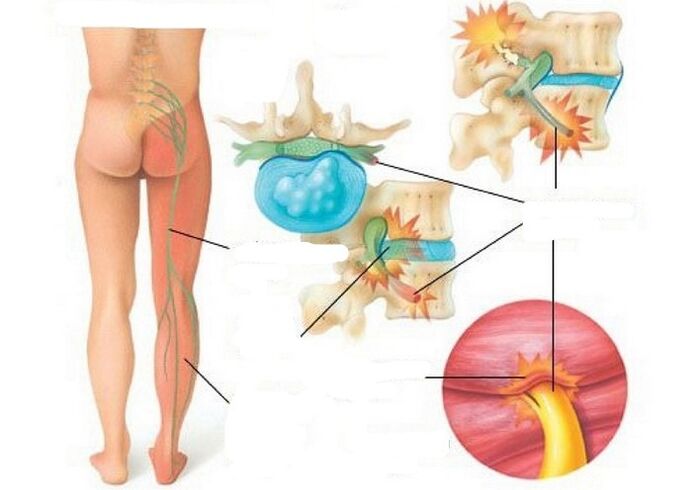 Types et causes de douleur