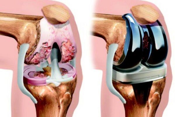 Avant et après l'endoprothétique de l'articulation du genou avec l'arthrose