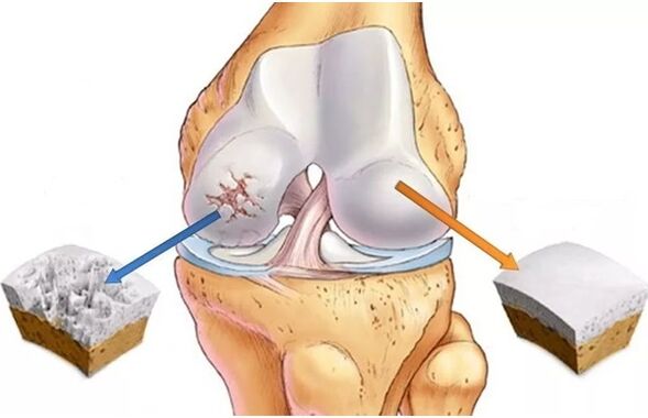Cartilage et cartilage sain, qui est affecté par l'arthrose