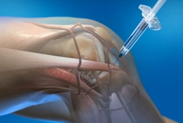 injections intra-karticulaires pour l'arthrose de l'articulation du genou